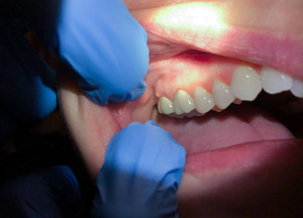 Best Emergency Dental Extractions in Nash, TX